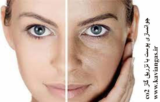 کربوکسی تراپی-سپهر گاز کاویان